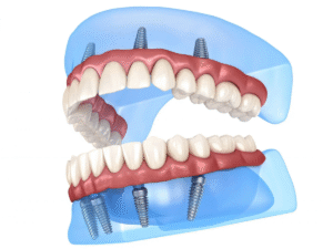 3D illustration showing how same day dental implants are placed in the upper and lower jaw.