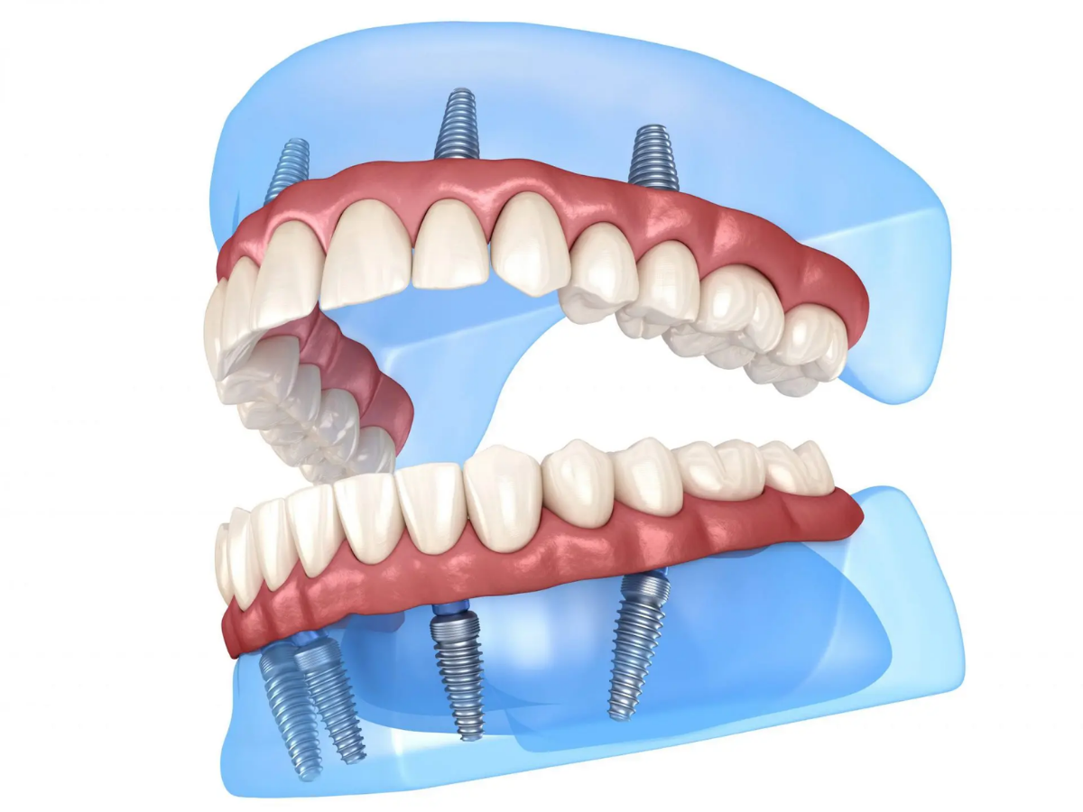 3D illustration showing how same day dental implants are placed in the upper and lower jaw.