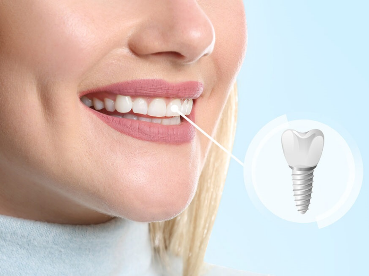 Close-up of a smiling woman with a visual illustration of a dental implant beside her, representing same day implant treatment.