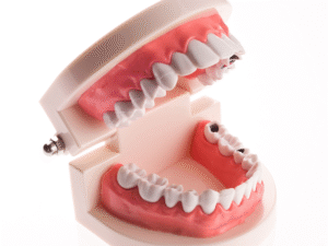 Dental implant model showing missing teeth and restored implants