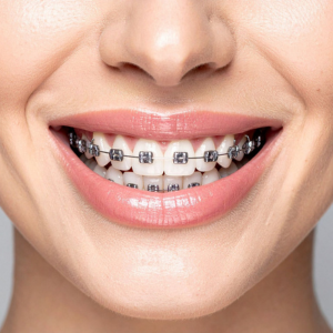 close up of teeth with metal braces during orthodontic treatment